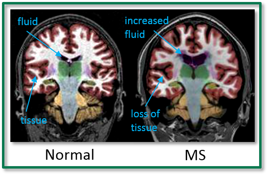 ms mri brain scan results