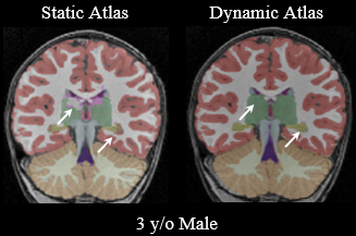 dynamic_atlas_3YO.png