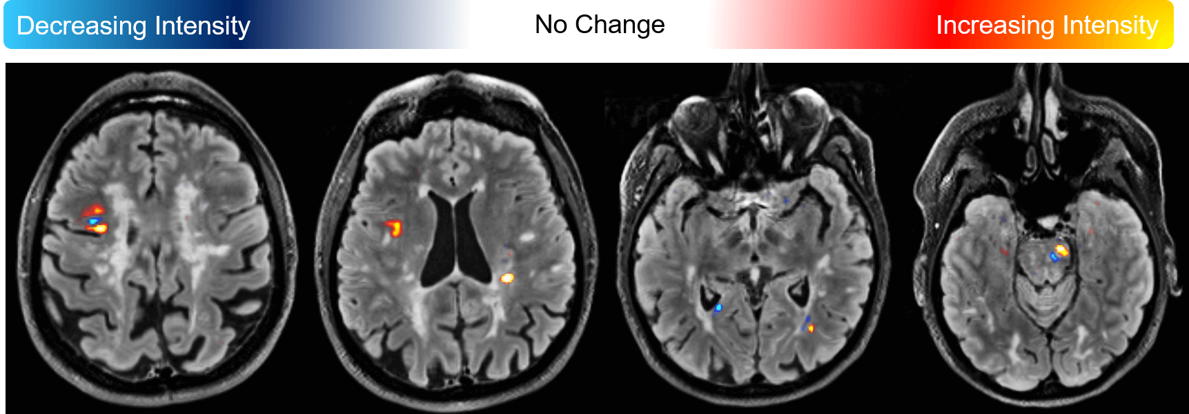 Cortechs.ai | Lesion Change Visualization with LesionQuant 2.3