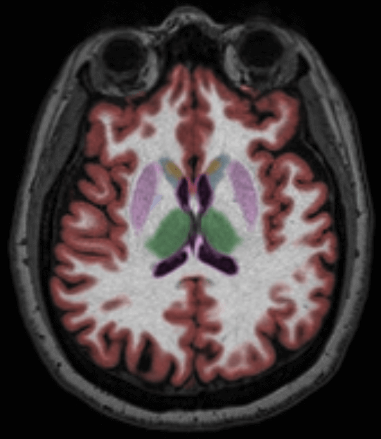 Cortechs.ai | The Role of Volumetric Neuroimaging in the Evaluation of Huntington’s Disease
