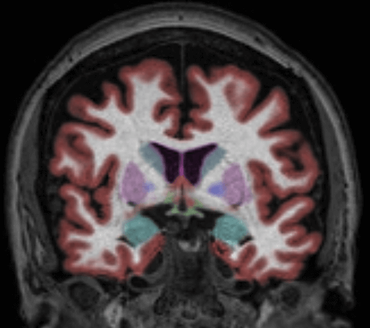 Cortechs.ai | The Role of Volumetric Neuroimaging in the Evaluation of Huntington’s Disease