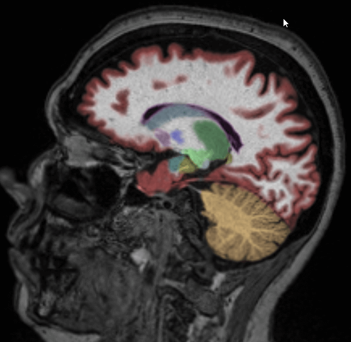 Cortechs.ai | The Role of Volumetric Neuroimaging in the Evaluation of Huntington’s Disease