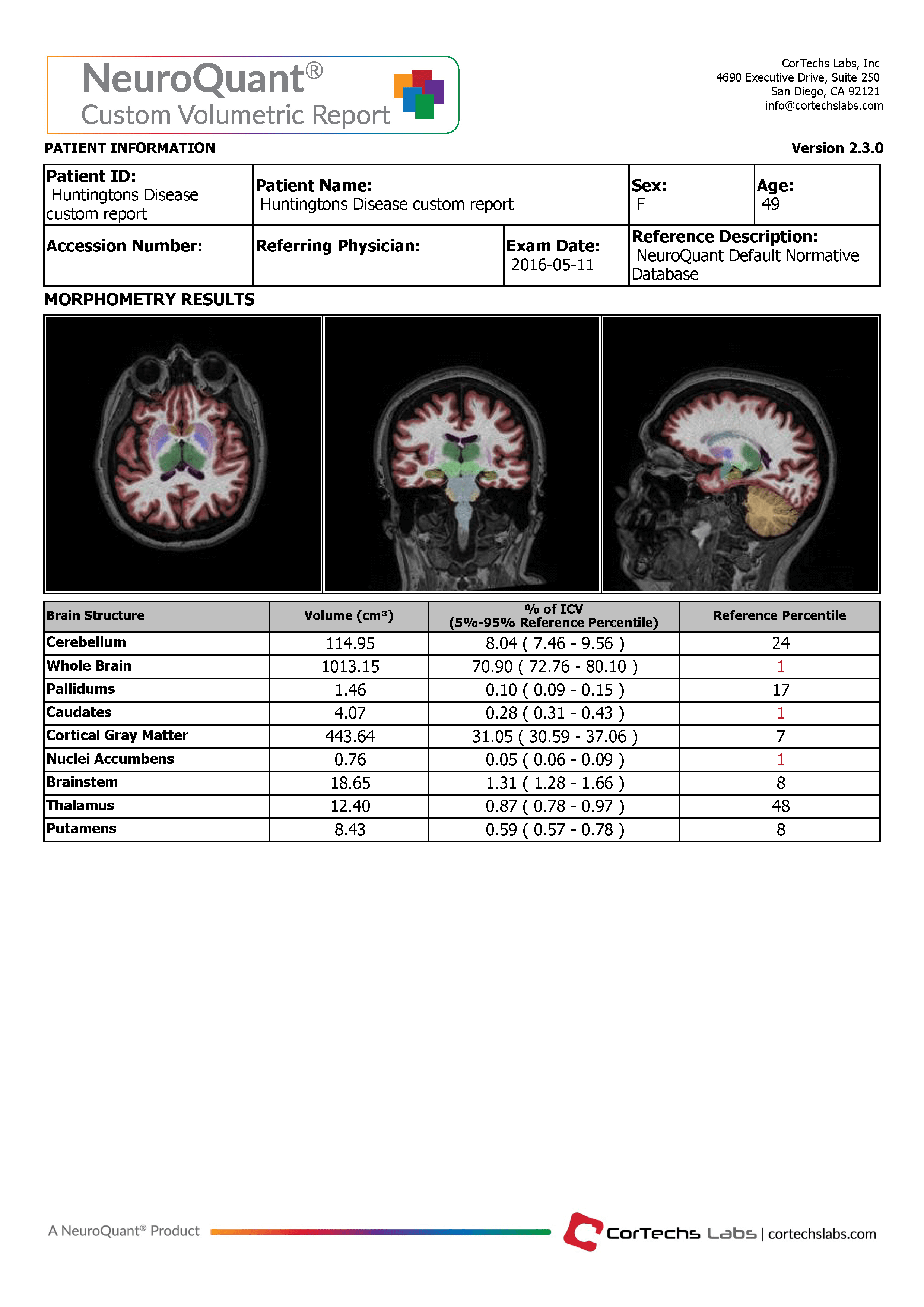 Cortechs.ai | The Role of Volumetric Neuroimaging in the Evaluation of Huntington’s Disease