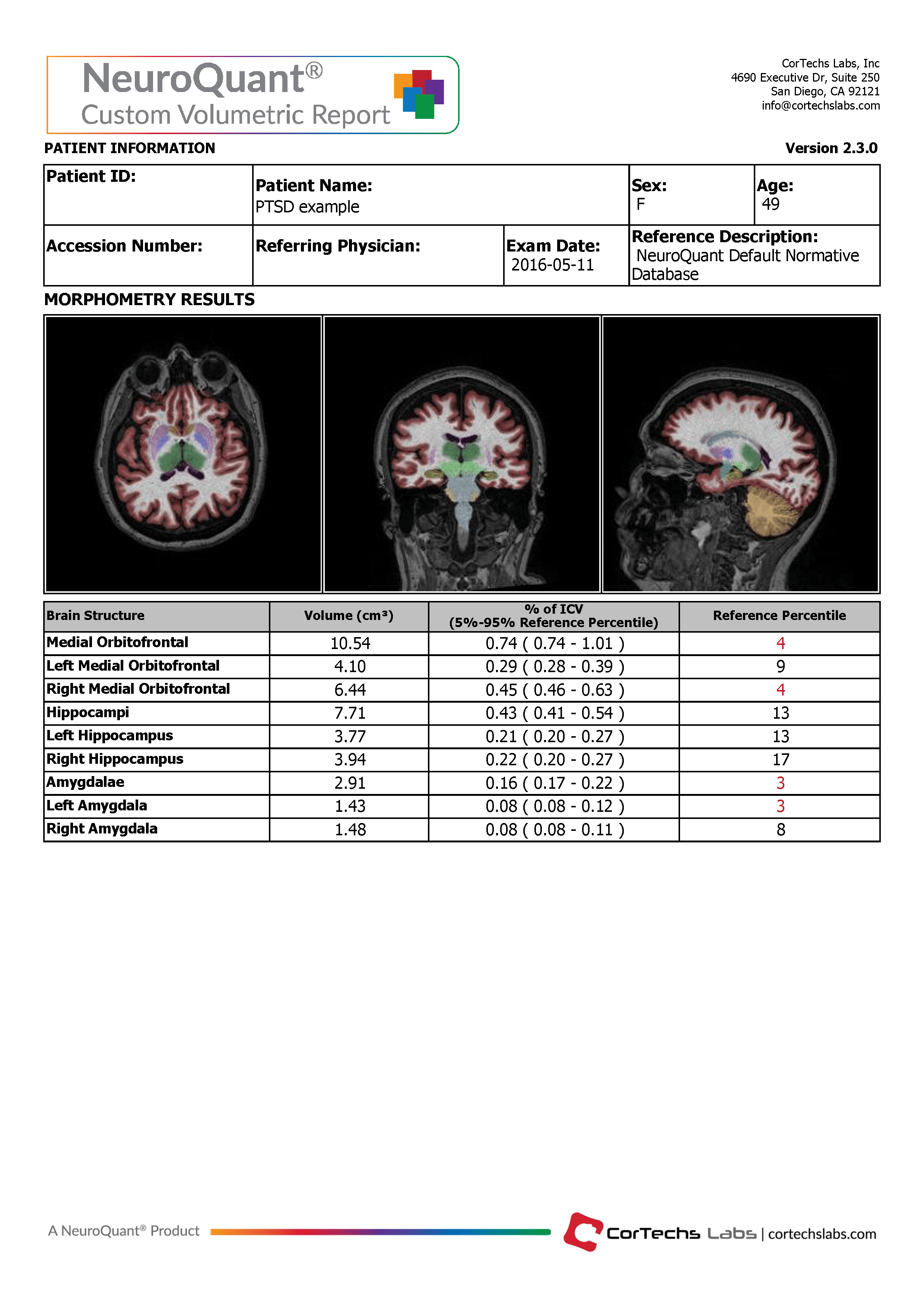 Cortechs.ai | The Role of Volumetric Neuroimaging in the Evaluation of PTSD