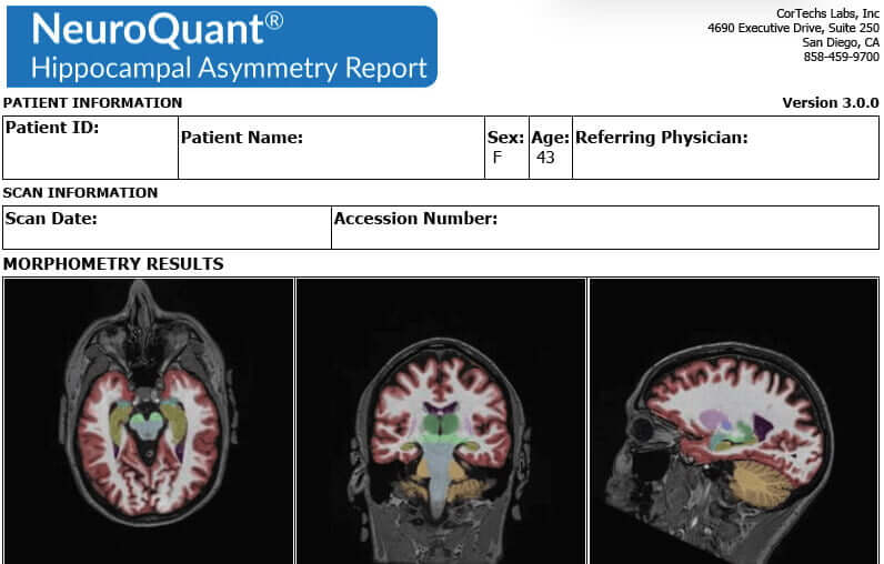 NeuroQuant Seizure Report