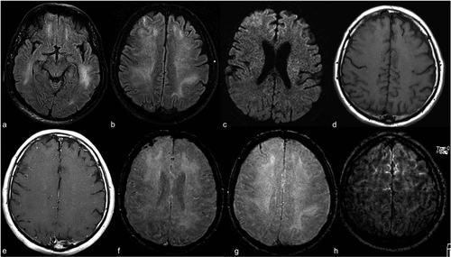 Cortechs.ai | COVID-19 neurological manifestations and brain volumetrics