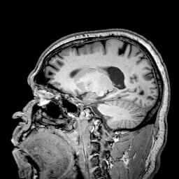 NeuroQuant MS Mockup - Cortechs.ai