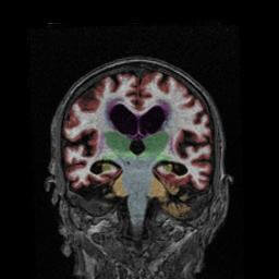 Cortechs.ai | Early and accurate diagnosis of Alzheimer’s disease