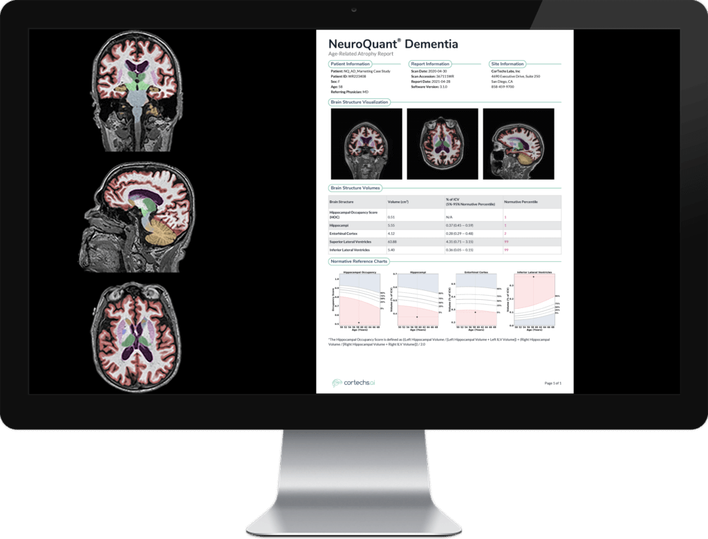 NeuroQuant Dementia Output