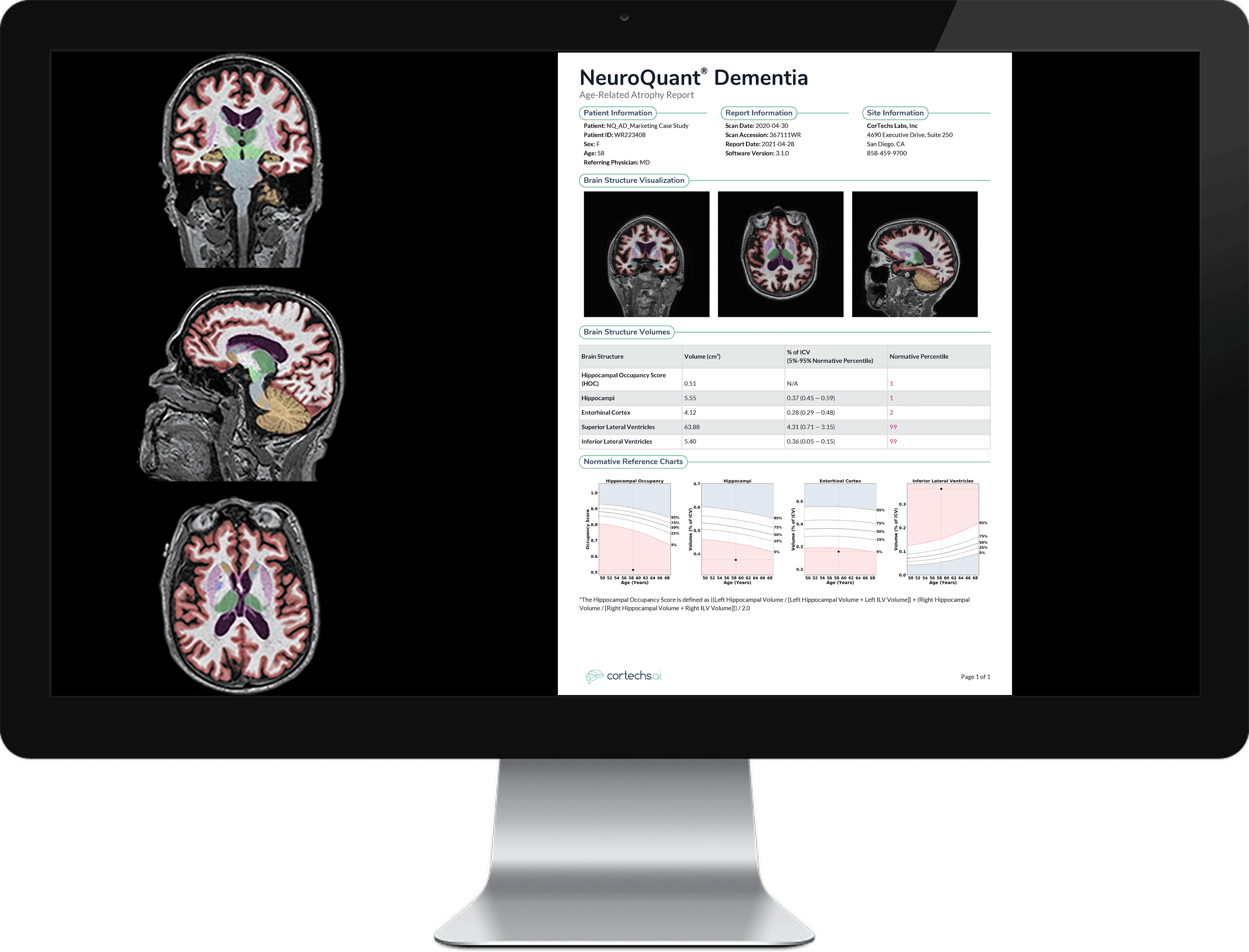 Early and Accurate Diagnosis of Alzheimer’s Disease: NeuroQuant Case Study