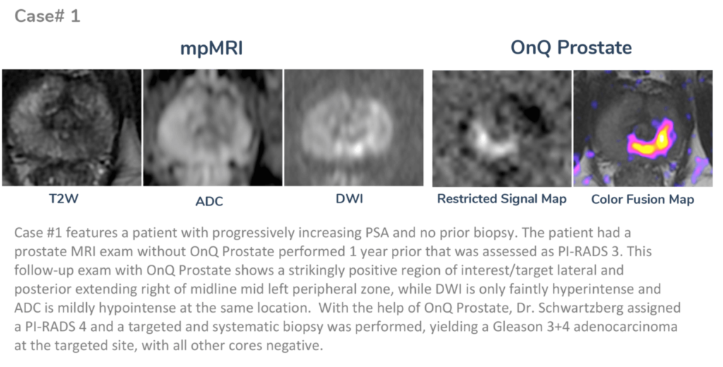 Scan of a patient with progressively increasing PSA and no prior biopsy.