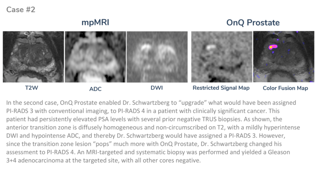 Case 2 scan using OnQ Prostate
