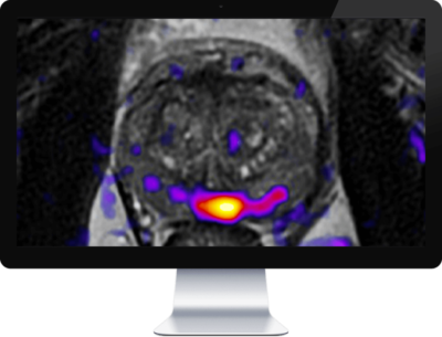 OnQ Prostate Color Fusion Map