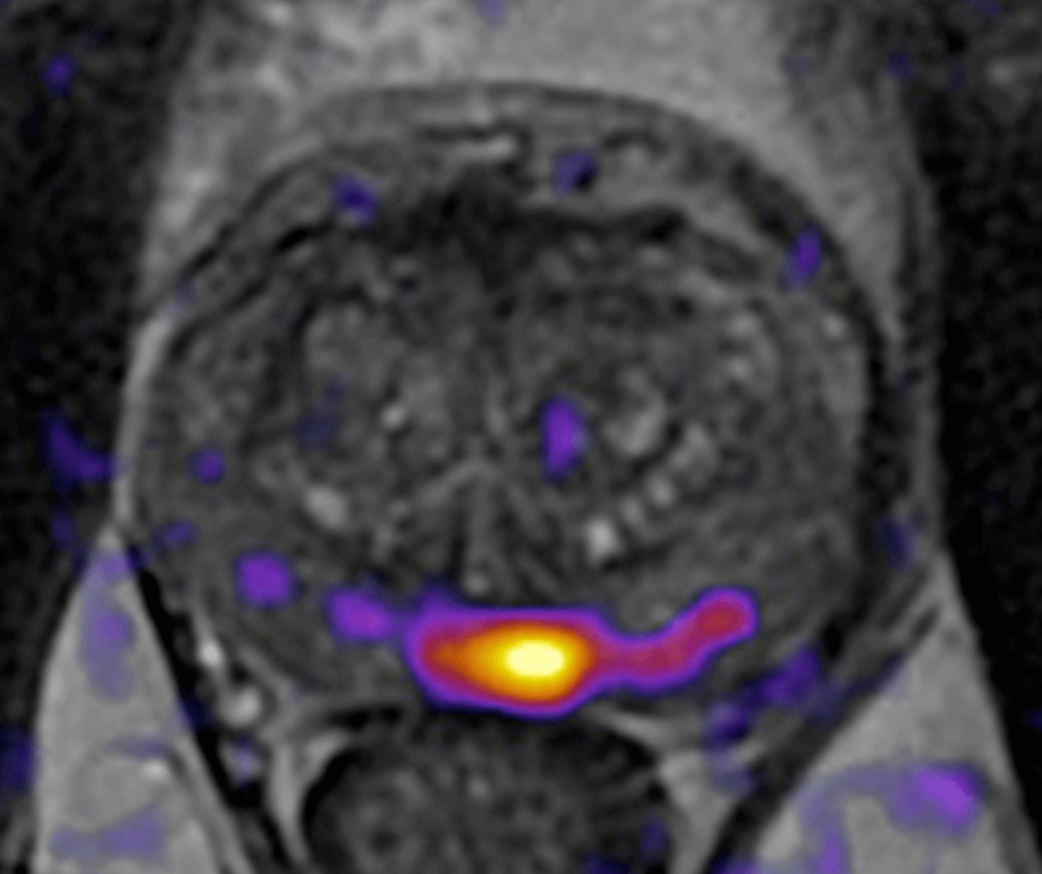 OnQ Prostate