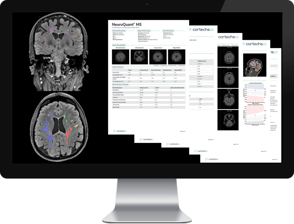 NeuroQuant MS on computer