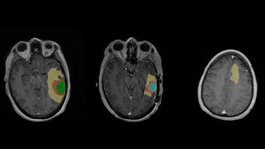 Cortechs.ai | NeuroQuant® Brain Tumor: Case Study
