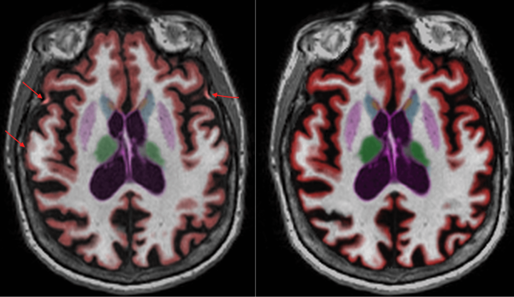 Neurowquant NeuroQuant 4.0: TBA Report updates - Cortechs.ai