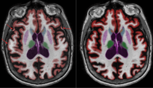 Cortechs.ai | NeuroQuant 4.0: TBA Report updates