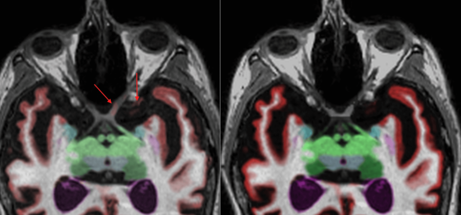 Neurowquant NeuroQuant 4.0: TBA Report updates - Cortechs.ai