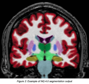 Example of NeuroQuant 4.0 segmentation