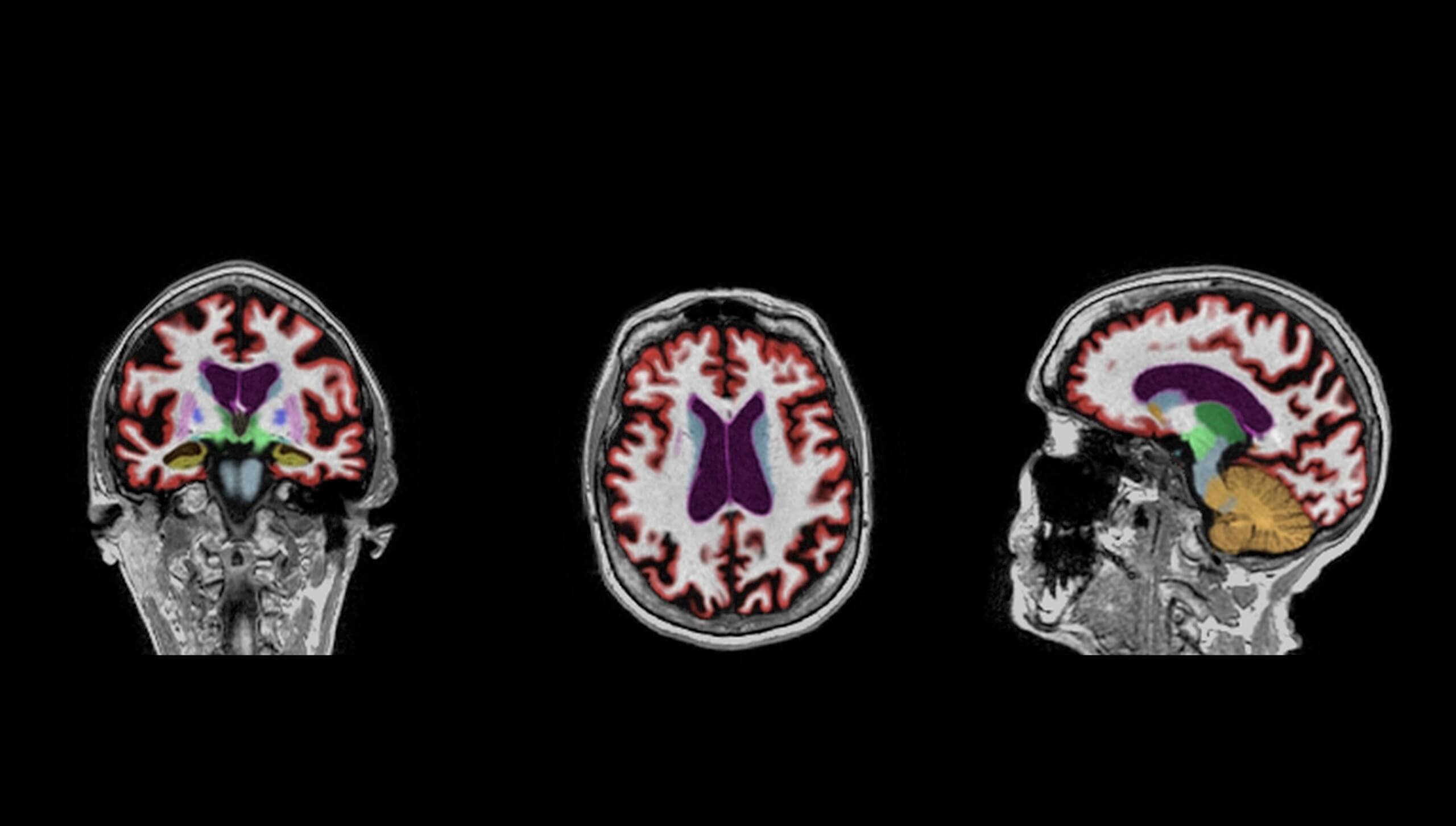 NeuroQuant 4.0: Improved Segmentation with New Hybrid ML/DL Model