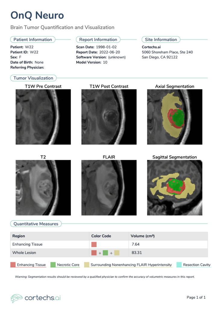 OnQ Report showcasing a single timepoint, preoperative high-grade glioma case.
