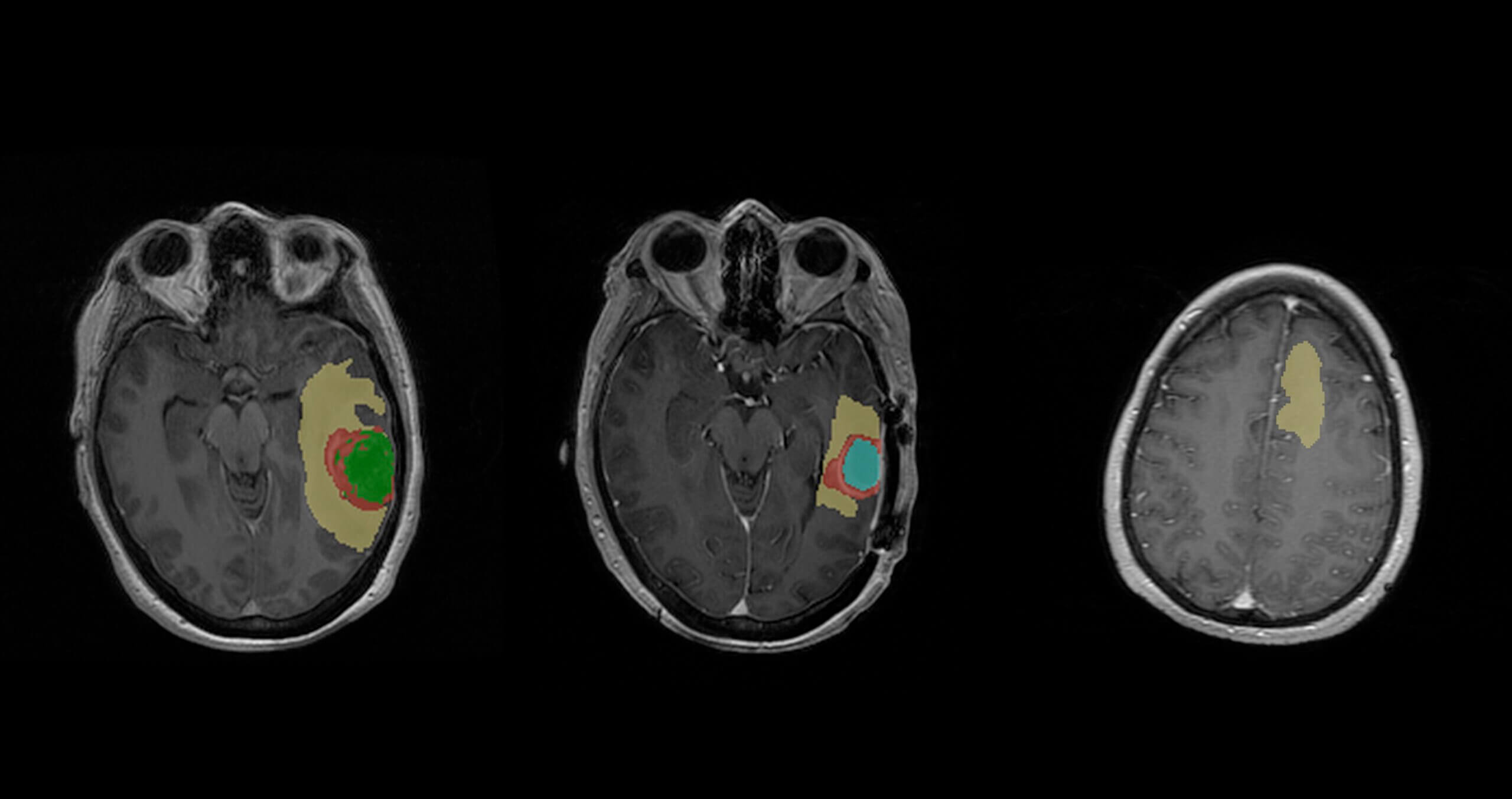 OnQ Neuro: Case Study