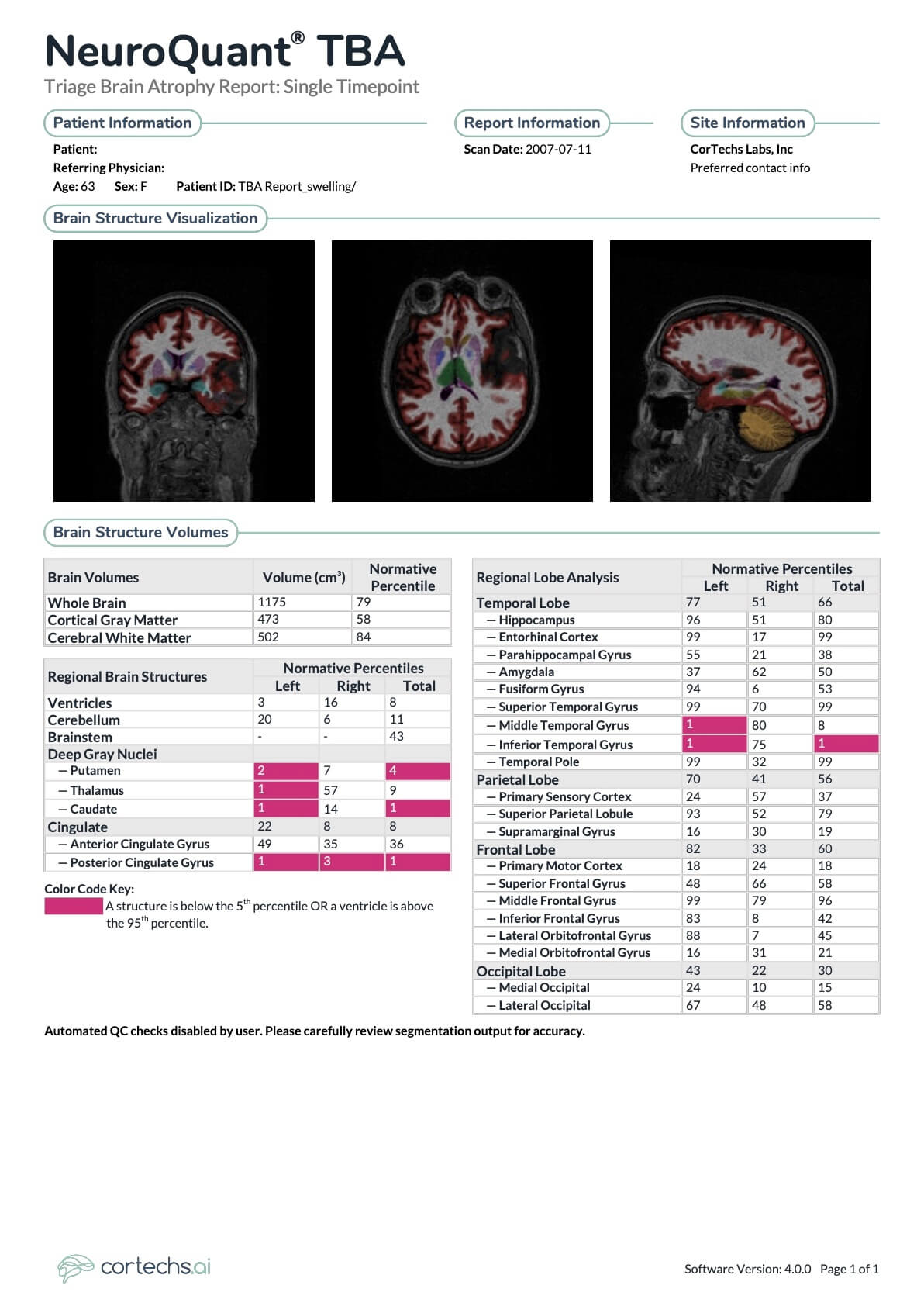 NeuroQuant 4.0: TBA Report Updates & Traumatic Brain Injuries