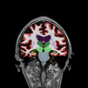 Cortechs.ai | Identifying Alzheimer’s disease with NeuroQuant