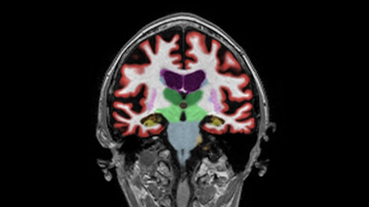 Cortechs.ai | Identifying Alzheimer’s disease with NeuroQuant