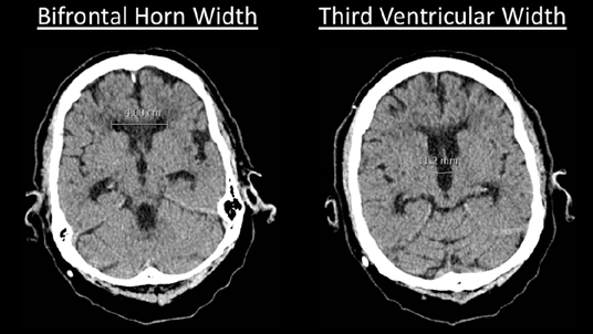 Cortechs.ai | Auto CT registration improves sensitivity to ventricular volume change