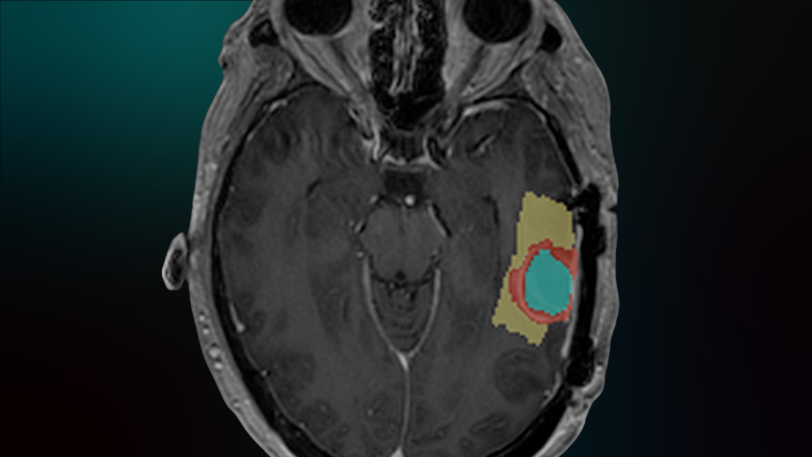 Cortechs.ai | Deep Learning Segmentation Of Infiltrative And Enhancing Cellular Tumor In Post-Treatment Glioblastoma Patients With Multi-Shell Diffusion MRI