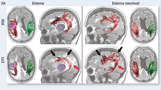 Cortechs.ai | Diffusion-weighted imaging in cancer