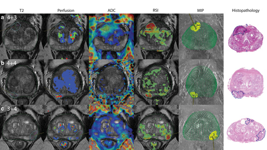 Cortechs.ai | In vivo prostate cancer detection and grading using RSI-MRI
