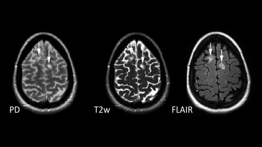 Cortechs.ai | NeuroQuant<sup>®</sup> MS performance evaluation