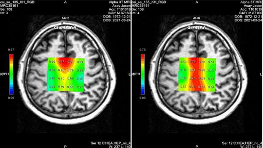 Cortechs.ai | NeuroQuant TBA 4.0: TBI case study