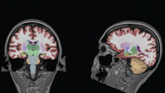 Cortechs.ai | Quantitative MR volumetry in temporal lobe epilepsy