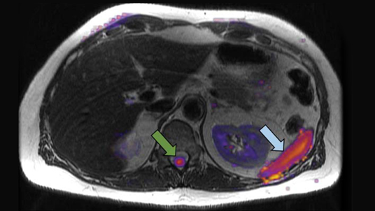 Cortechs.ai | Restriction Spectrum Imaging: an evolving imaging biomarker