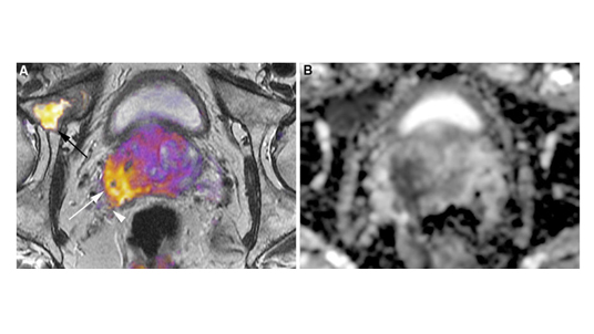 Cortechs.ai | Restriction Spectrum Imaging (RSI) improves cancer detection