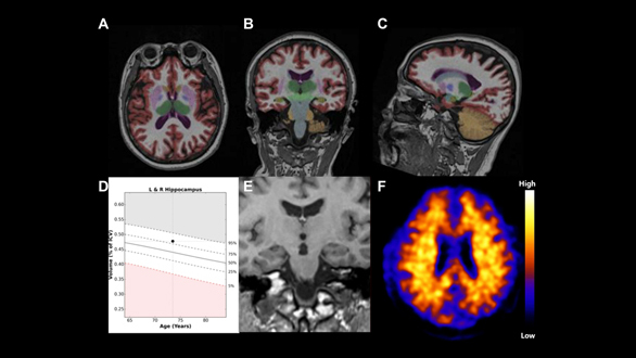 Cortechs.ai | Volumetric quantification of focal atrophy in AD