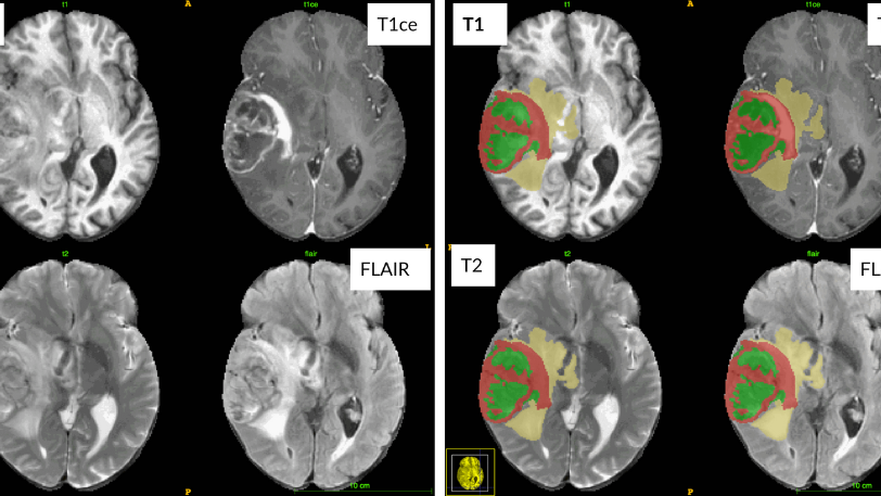 Cortechs.ai | Segmentation Of Pre And Post-Treatment Glioma Tissue Types Including Resection Cavities