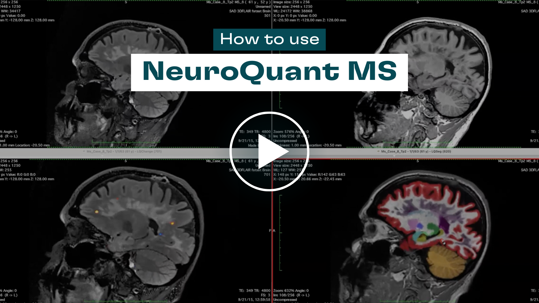 Cortechs.ai | NeuroQuant MS