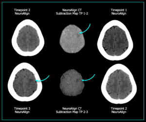 Cortechs.ai | How NeuroAlign CT Subtraction Maps Enhance Detection and Confidence in Neuroradiology