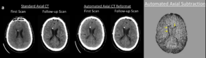 Cortechs.ai | How NeuroAlign CT Subtraction Maps Enhance Detection and Confidence in Neuroradiology