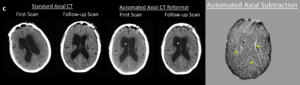Cortechs.ai | How NeuroAlign CT Subtraction Maps Enhance Detection and Confidence in Neuroradiology