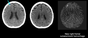 Cortechs.ai | How NeuroAlign CT Subtraction Maps Enhance Detection and Confidence in Neuroradiology