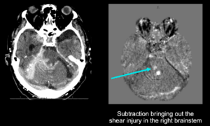 Cortechs.ai | How NeuroAlign CT Subtraction Maps Enhance Detection and Confidence in Neuroradiology