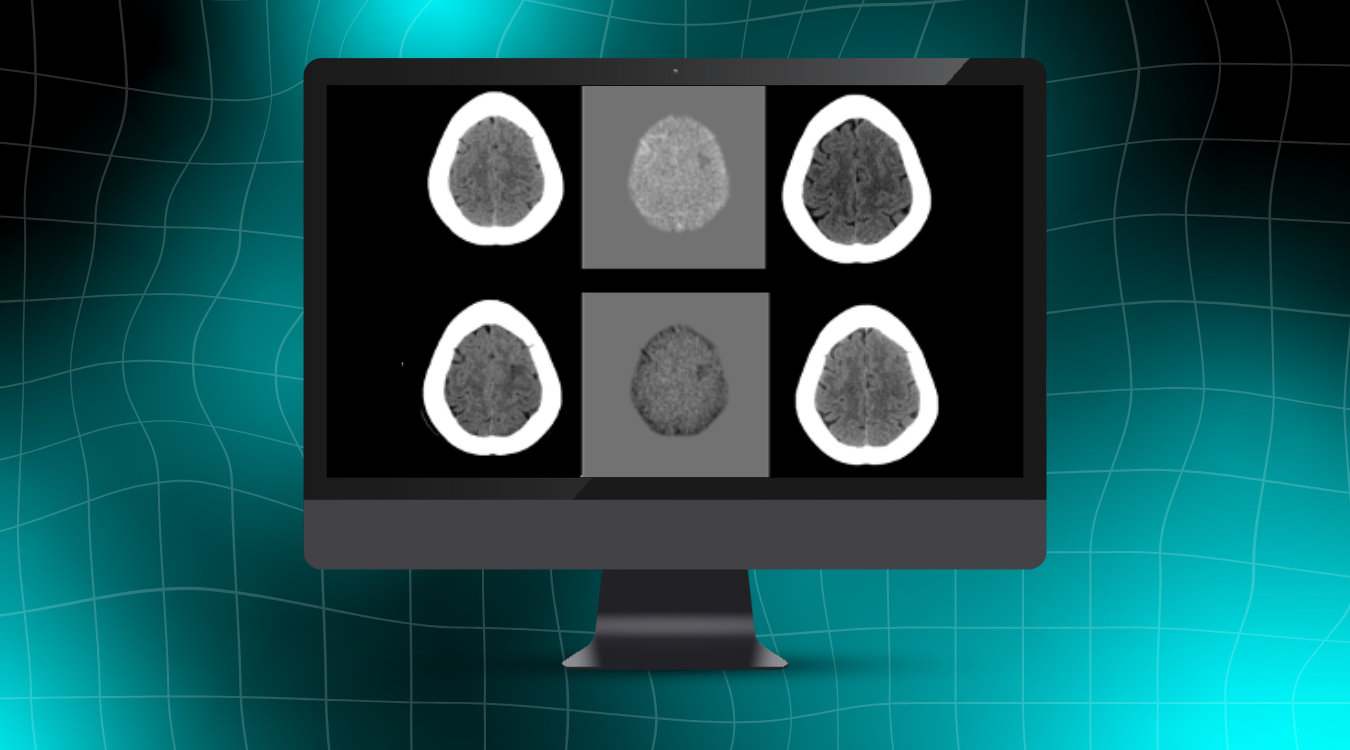 Cortechs.ai|How NeuroAlign CT Subtraction Maps Enhance Detection and Confidence in Neuroradiology