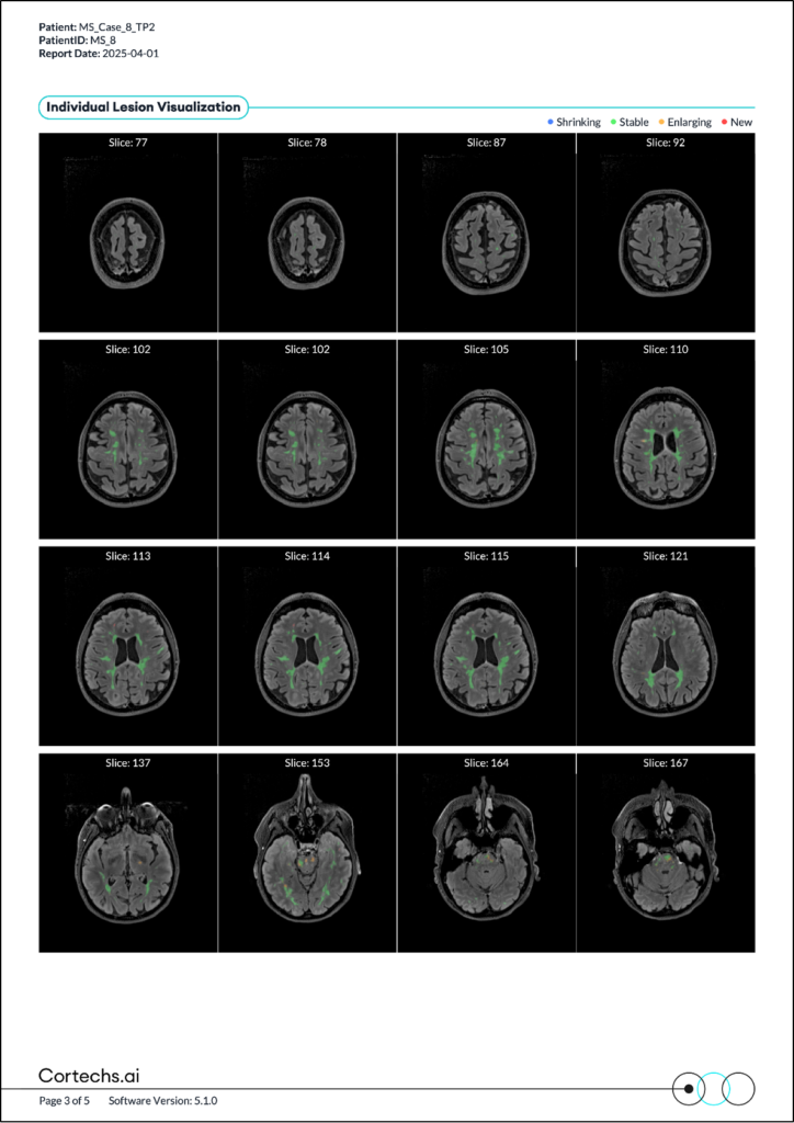 Cortechs.ai | Introducing NeuroQuant MS Lesion Dynamics Computation: A Clearer Path to Understanding Disease Progression