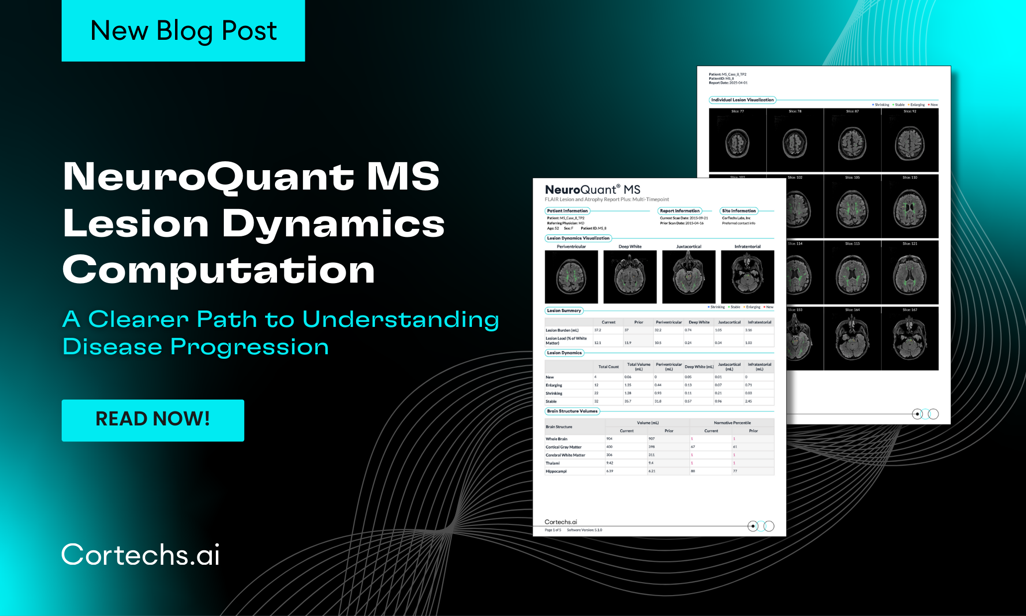 Cortechs.ai | Introducing NeuroQuant MS Lesion Dynamics Computation: A Clearer Path to Understanding Disease Progression